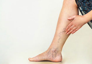 Điều trị suy giãn tĩnh mạch bằng Đông y hiệu quả, an toàn và tự nhiên